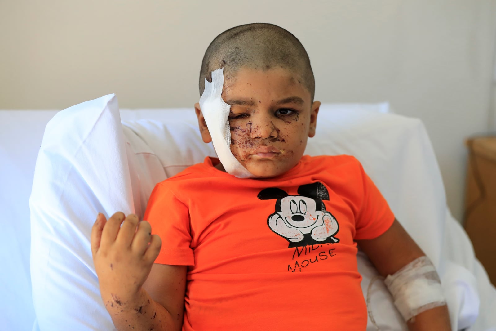 Ali Abdel Rahman Zorout, 5, who was wounded in an Israeli airstrike, poses for a picture at the Alaaeddine Hospital in Sarafand, south Lebanon, Thursday, Sept. 26, 2024. (AP Photo/Mohammed Zaatari)